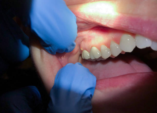 Best Emergency Treatment for Toothache in Oroville, CA